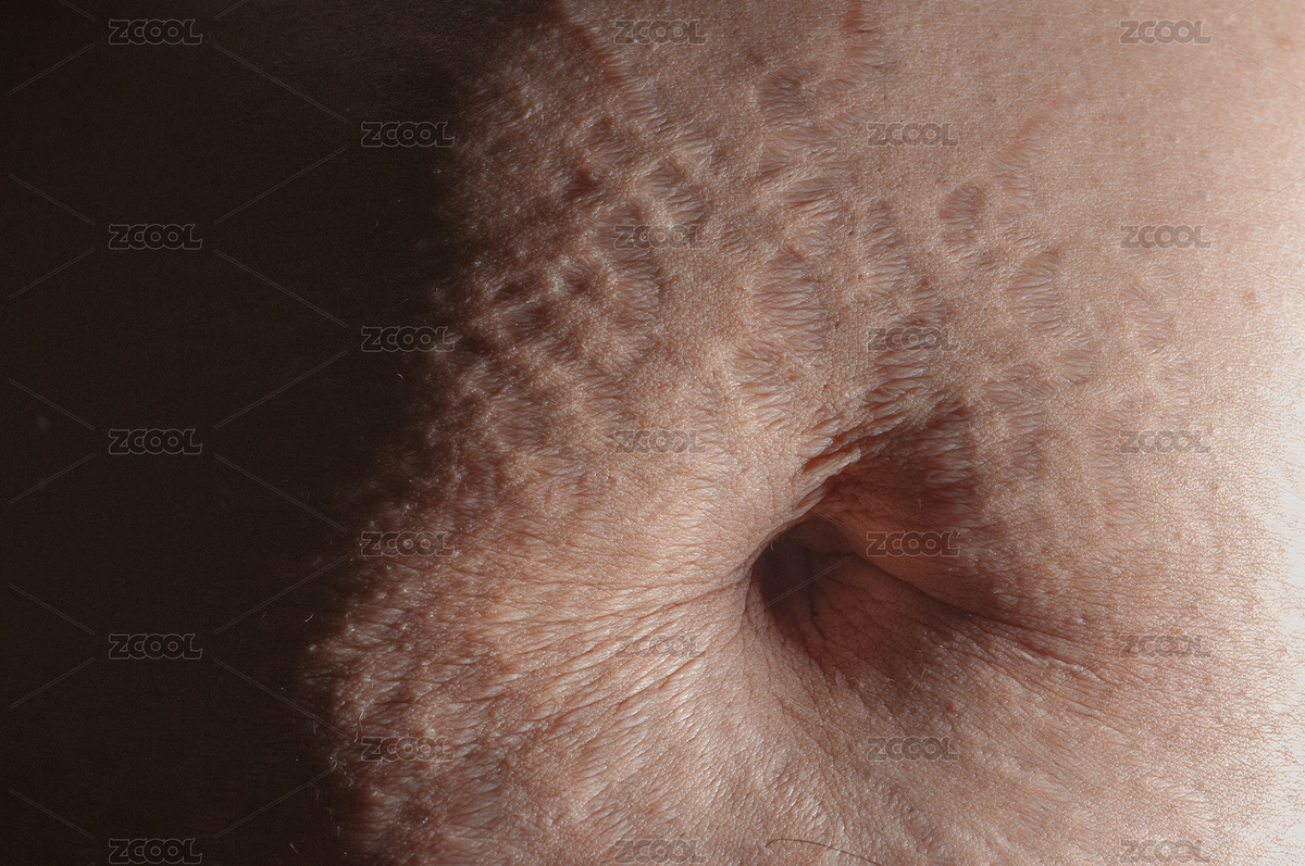 生完孩子后肚子上的妊娠紋（主預(yù)覽-7956700） - 未分類 - 站酷設(shè)計師ZHAODAN87原創(chuàng)素材 - 站酷ZCOOL