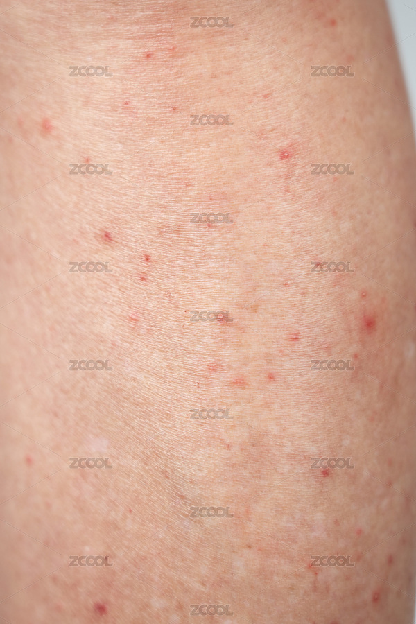 腿部的紅點(diǎn)過(guò)敏性皮炎（主預(yù)覽-10245780） - 未分類 - 站酷設(shè)計(jì)師平和的總是美好的原創(chuàng)素材 - 站酷ZCOOL
