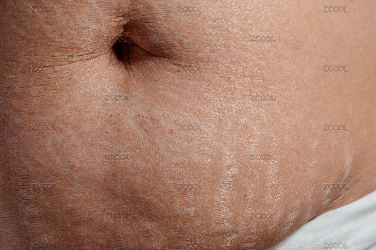 生完孩子后肚子上的妊娠紋（主預(yù)覽-2680330） - 未分類 - 站酷設(shè)計(jì)師ZHAODAN87原創(chuàng)素材 - 站酷ZCOOL