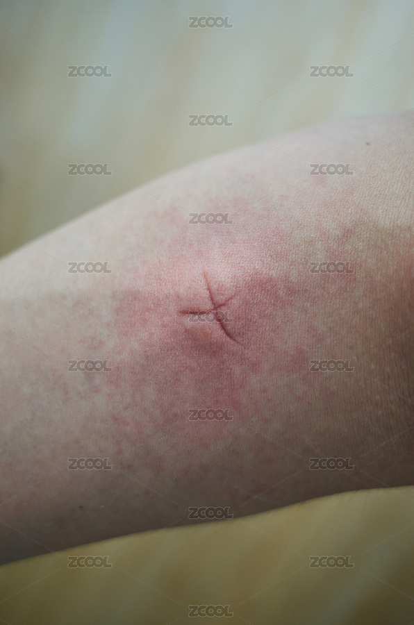 手臂上被蚊蟲叮咬后產(chǎn)生的紅腫包塊（主預(yù)覽-3227568） - 未分類 - 站酷設(shè)計(jì)師蔚藍(lán)的白日夢(mèng)原創(chuàng)素材 - 站酷ZCOOL