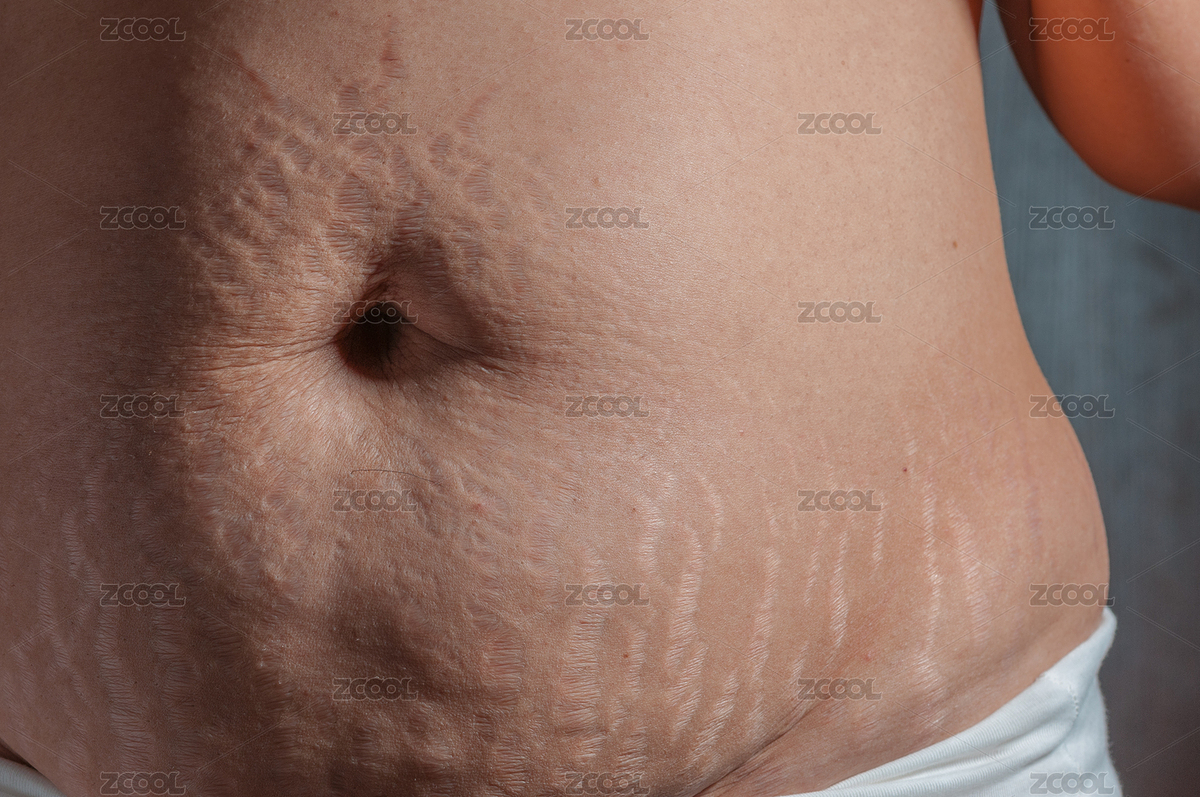 生完孩子后肚子上的妊娠紋（主預(yù)覽-7393132） - 未分類 - 站酷設(shè)計(jì)師ZHAODAN87原創(chuàng)素材 - 站酷ZCOOL