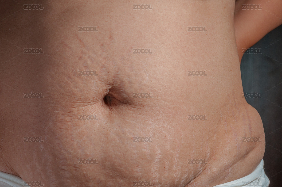 生完孩子后肚子上的妊娠紋（主預(yù)覽-285124） - 未分類 - 站酷設(shè)計(jì)師ZHAODAN87原創(chuàng)素材 - 站酷ZCOOL