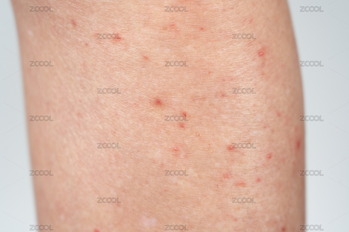 腿部的紅點過敏性皮炎（主預(yù)覽-10245778） - 未分類 - 站酷設(shè)計師平和的總是美好的原創(chuàng)素材 - 站酷ZCOOL