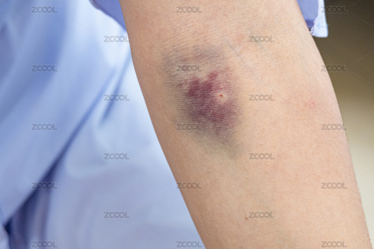 特写胳膊臂弯静脉抽血之后淤青（主预览-3819584） - 未分类 - 站酷设计师马胜轻原创素材 - 站酷ZCOOL