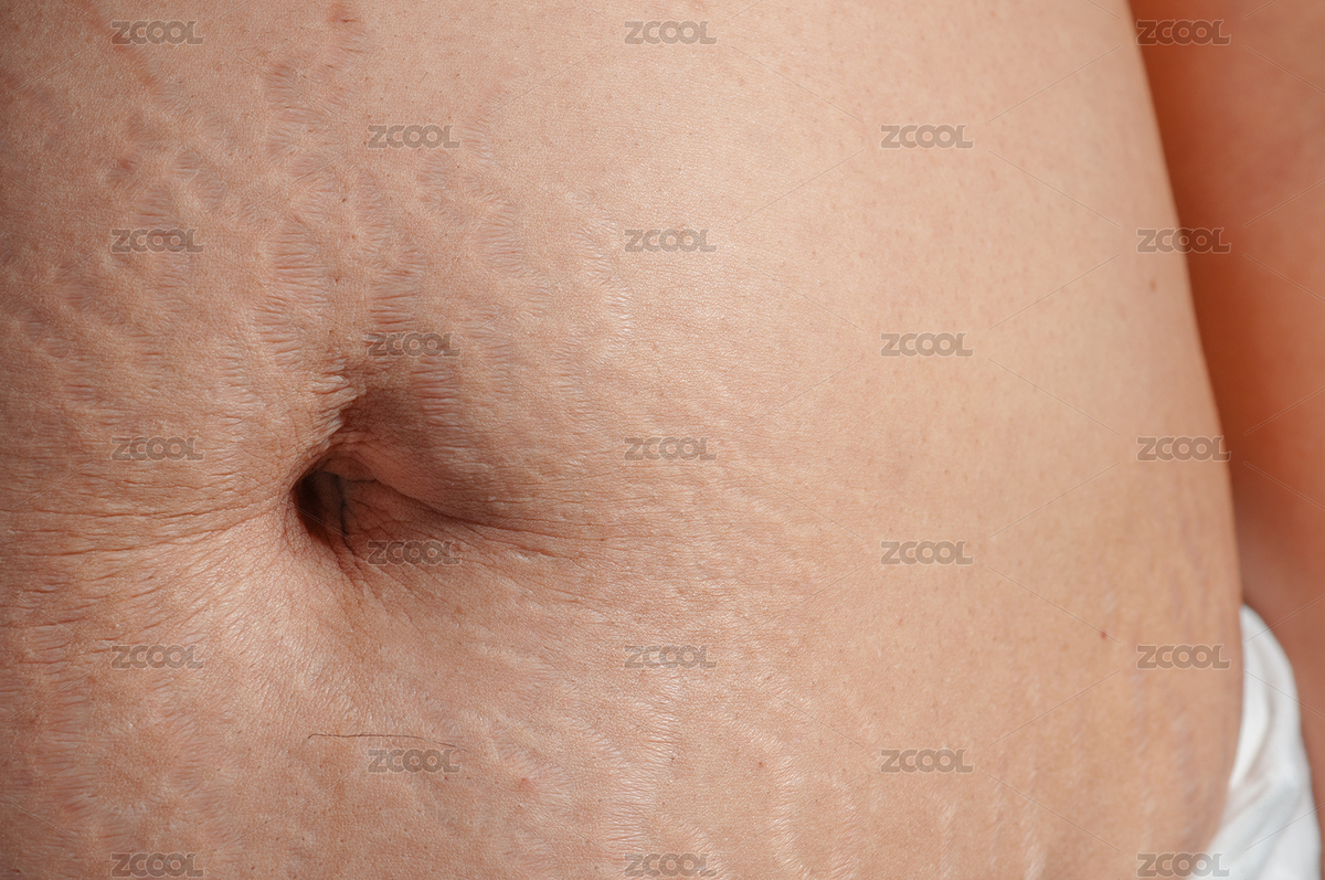 生完孩子后肚子上的妊娠紋（主預(yù)覽-1495620） - 未分類 - 站酷設(shè)計師ZHAODAN87原創(chuàng)素材 - 站酷ZCOOL