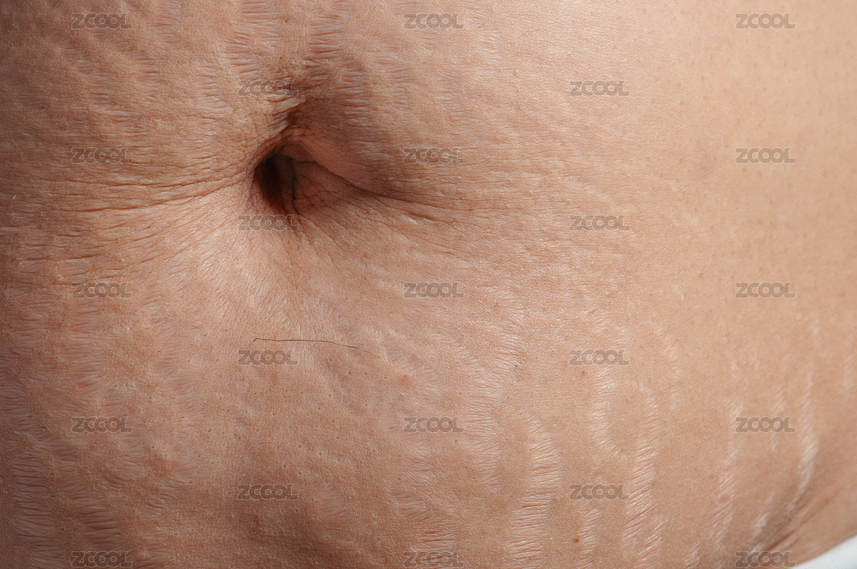 生完孩子后肚子上的妊娠紋（主預(yù)覽-6834916） - 未分類 - 站酷設(shè)計(jì)師ZHAODAN87原創(chuàng)素材 - 站酷ZCOOL