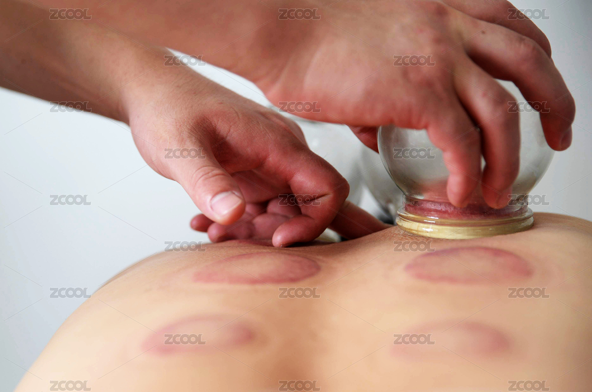 中醫(yī)拔火罐（主預(yù)覽-500319） - 未分類 - 站酷設(shè)計師好茶婁山春原創(chuàng)素材 - 站酷ZCOOL