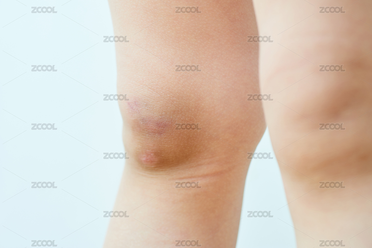 幼兒因摔傷而紅腫淤青的膝蓋（主預(yù)覽-4355581） - 未分類 - 站酷設(shè)計師蔚藍的白日夢原創(chuàng)素材 - 站酷ZCOOL