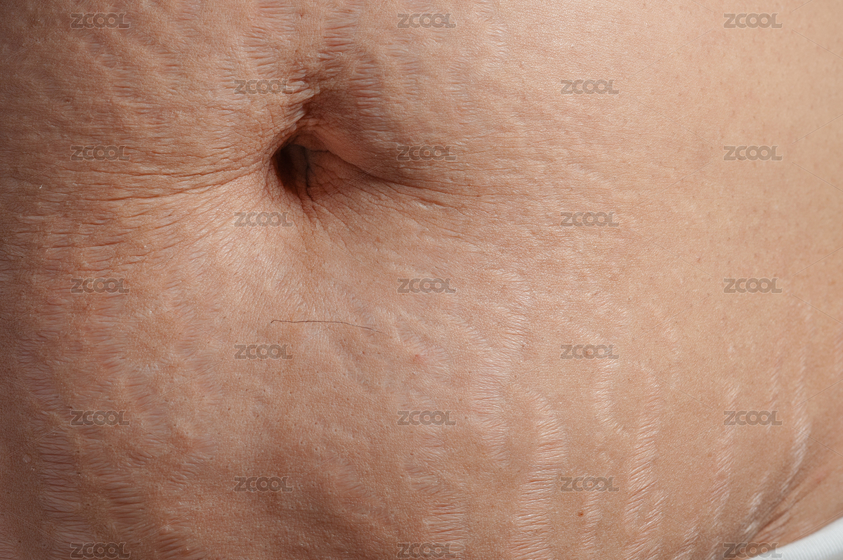 生完孩子后肚子上的妊娠紋（主預(yù)覽-4581773） - 未分類 - 站酷設(shè)計師ZHAODAN87原創(chuàng)素材 - 站酷ZCOOL