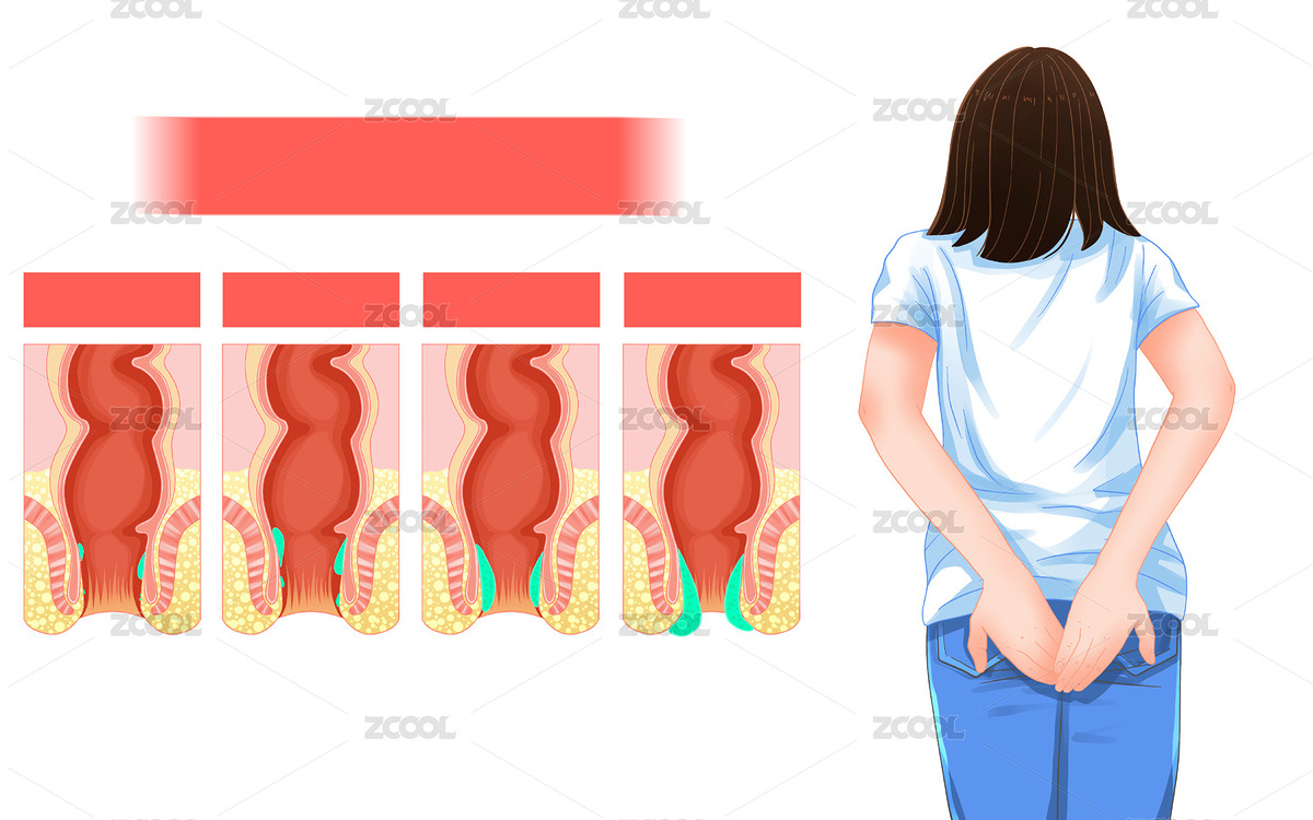 醫(yī)療健康痔瘡疼痛科普插畫（主預(yù)覽-6812575） - 未分類 - 站酷設(shè)計(jì)師萌萌的小姐姐原創(chuàng)素材 - 站酷ZCOOL