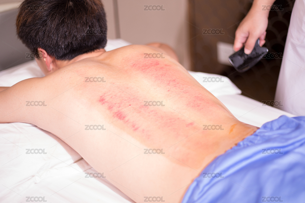 男士后背上的刮痧后的痧點（主預覽-4545064） - 未分類 - 站酷設計師simon54原創(chuàng)素材 - 站酷ZCOOL