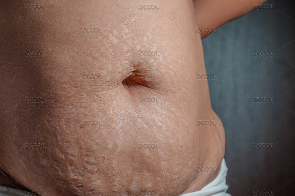 生完孩子后肚子上的妊娠紋（主預(yù)覽-1838703） - 未分類 - 站酷設(shè)計(jì)師ZHAODAN87原創(chuàng)素材 - 站酷ZCOOL