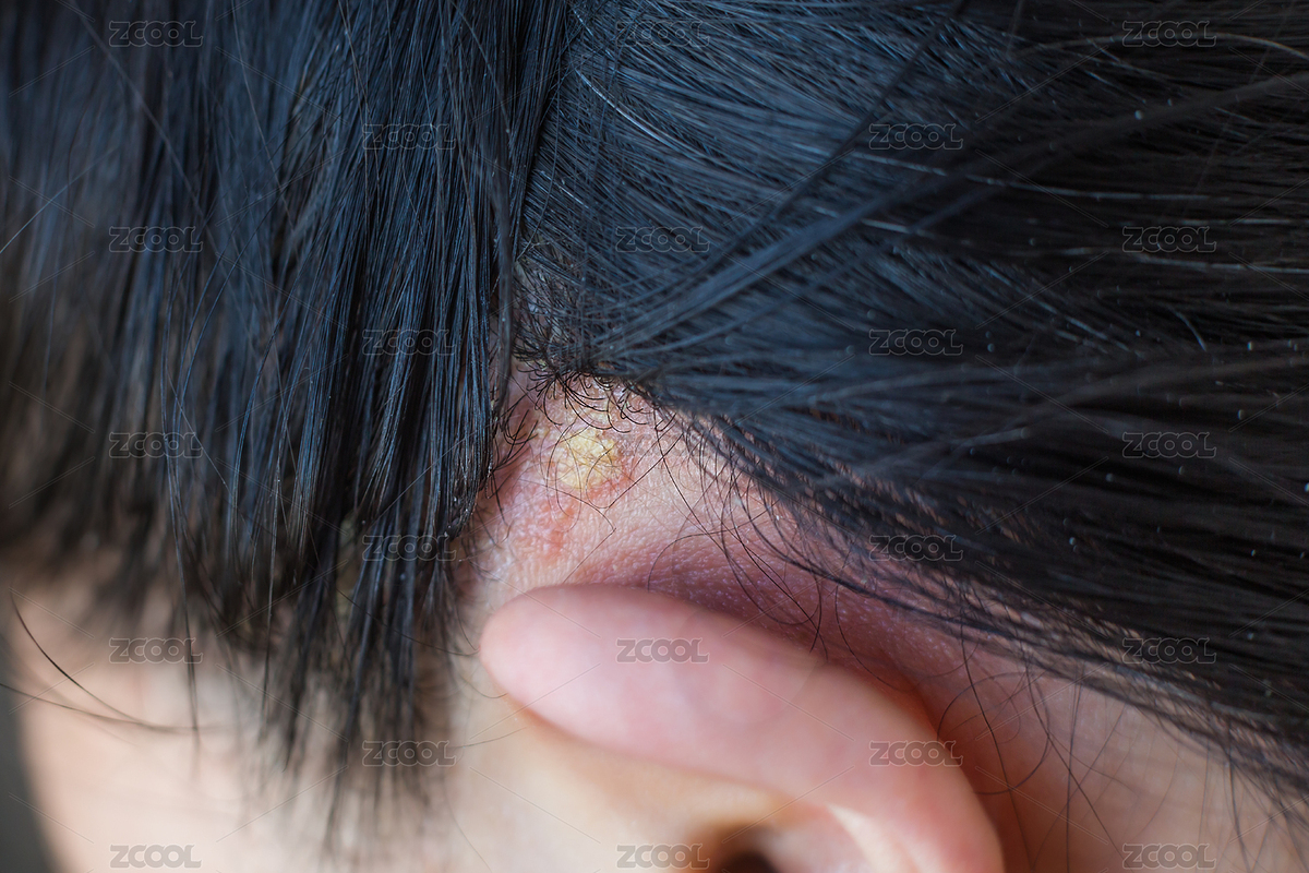 常見(jiàn)皮膚疾病皮炎圖片。（主預(yù)覽-3629620） - 未分類 - 站酷設(shè)計(jì)師Todo圖片原創(chuàng)素材 - 站酷ZCOOL